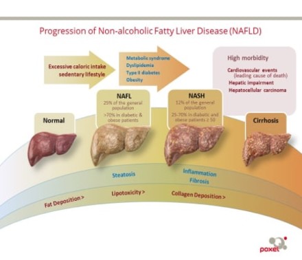 A Mechanism Of Disease 3D Illustration for Poxel that shows liver disease progression from normal to cirrhosis of the liver.